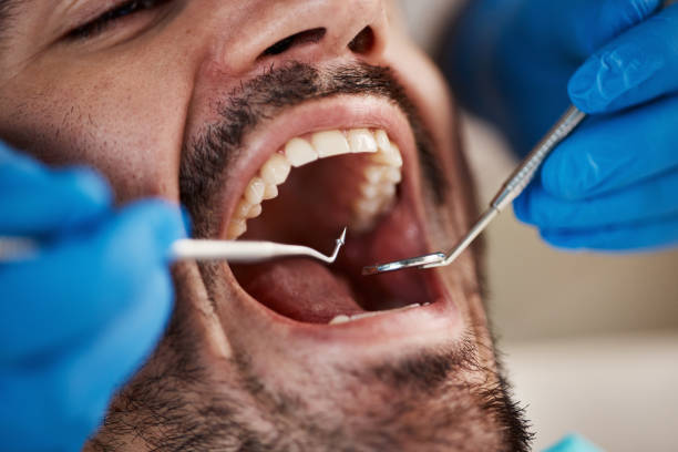 Best Chipped Tooth Repair Near Me  in Bonneau Beach, SC